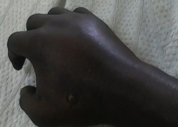 Crime de jalousie en République Dominicaine  : Un Haïtien a amputé l’avant-bras de son ex-partenaire d’un coup de machette