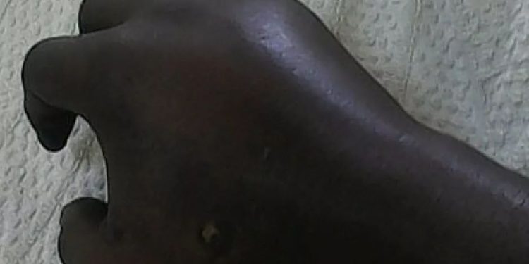 Crime de jalousie en République Dominicaine  : Un Haïtien a amputé l’avant-bras de son ex-partenaire d’un coup de machette